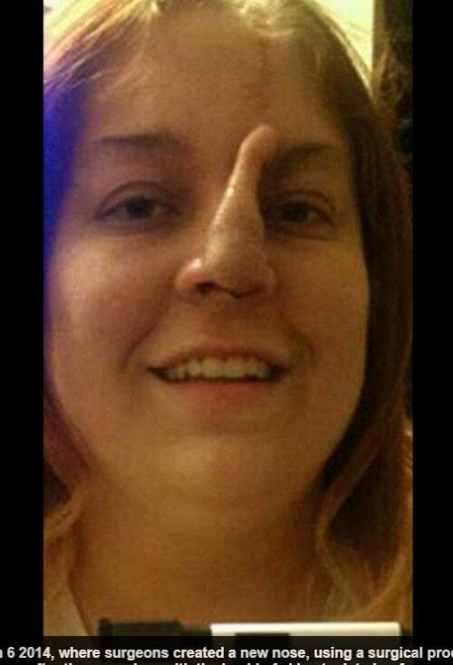 Uma mancha no nariz virou um dos maiores pesadelos de Bree Towner. A marca era na verdade um indício de câncer, que se desenvolveu rapidamente e desconfigurou o rosto da mulher. De acordo com informações do site DailyMail, ela teve de passar por diversas operações plásticas para reconstruir o rosto após se recuperar da doença