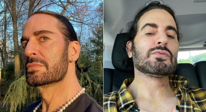 Marc Jacobs
O estilista Marc Jacobs não só fala dos procedimentos estéticos como mostra sem problemas o "outro lado" deles, com cicatrizes, curativos e tudo o que a recuperação envolve. Marc mostrou todas as etapas de um lifting, incluindo o uso de uma câmara de oxigênio, técnica chamada de oxigenoterapia hiperbárica, que ajuda a acelerar a cicatrização. Ele até disse, em tom de brincadeira, que vai ficar no mesmo estilo do personagem de Brad Pitt em O Curioso Caso de Benjamin Button, filme no qual o protagonista rejuvenesce em vez de envelhecer com o tempo