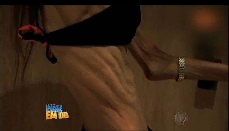 De acordo com a mulher, que preferiu não se identificar, a vontade de perder peso e ser magra começou ainda adolescente. Segundo ela, os amigos tiveram sarro por ela ser um pouco mais “gordinha”. Conheça a história da mulher que se alimentava somente com água e mamão