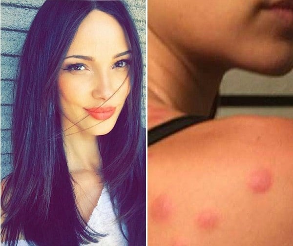 A modelo brasileira Sabrina Jales St. Pierre decidiu entrar com um processo contra a rede de hotéis Hilton e contra a California Embassy Suites por uma razão inusitada. Sabrina alega ter sofrido um ataque de percevejos quando esteve hospedada em Palm Desert, na Califórnia, em 2016. 