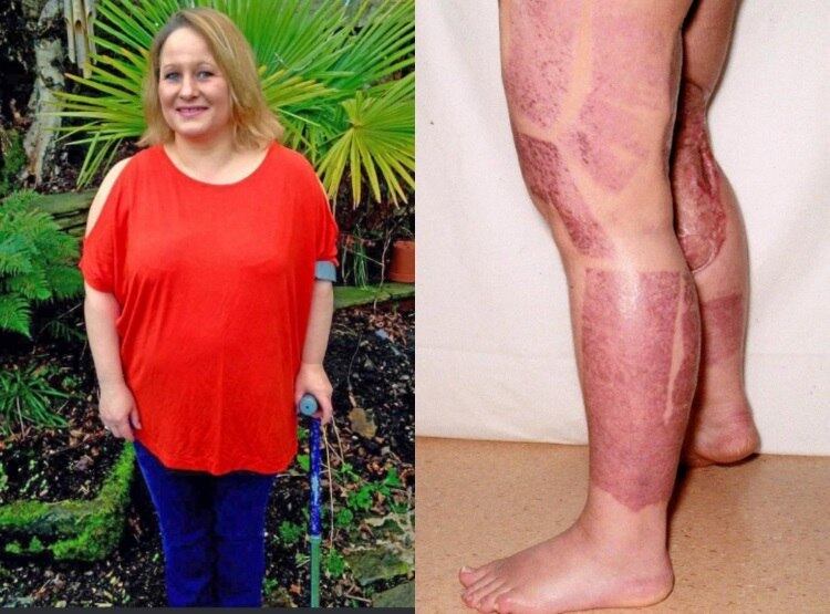 Dana Sedgewick, de 44 anos, quase morreu depois de adquirir uma infecção por “bactéria comedora de carne” após raspar a virilha com uma lâmina. A mulher chegou a entrar em coma por nove dias e passou por 21 cirurgias. As informações são do jornal The Sun