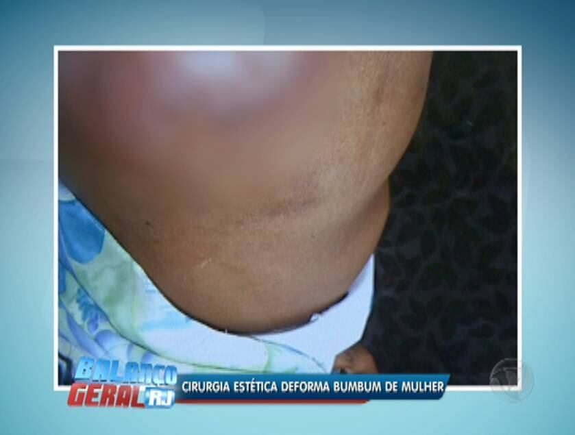 No procedimento cirúrgico, dois anos atrás, foi feita a aplicação de uma substância sintética polimetilmetacrilato, utilizada para preencher regiões do corpo e dar sustentabilidade às nádegas. Apesar de a cirurgia ser liberada pela Anvisa, muitos profissionais são contra a aplicação da substância em razão da possibilidade de rejeição do corpo