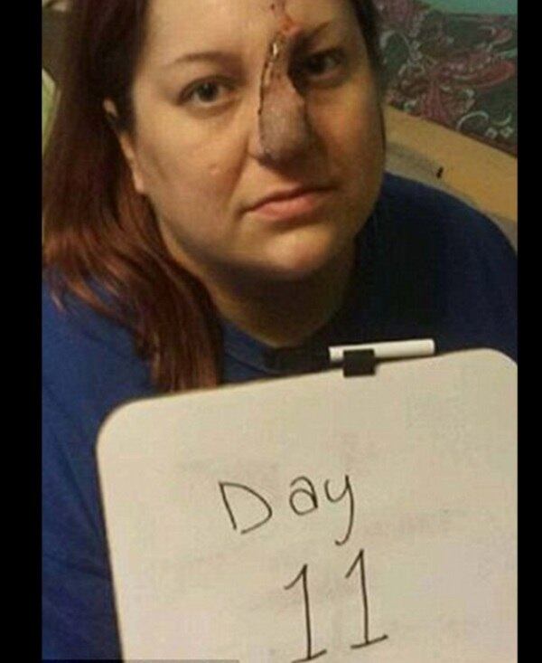 — Eu já tinha problemas de estresse e autoestima antes disso.
Com a doença eu quase fiquei depressiva. Foi muito difícil me ver daquele jeito