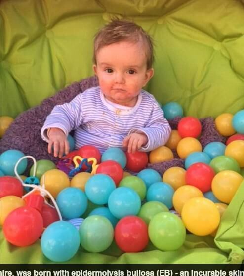 Nos primeiros meses, Jamie sofria muito mais. Podiam explodir cerca de 80 bolhas no corpo dele por dia e Katie ficava até 2 horas cobrindo as feridas. Hoje, ela demora até 20 minutos para trocar a fralda do filho, protegendo toda a pele dele para evitar novas feridas