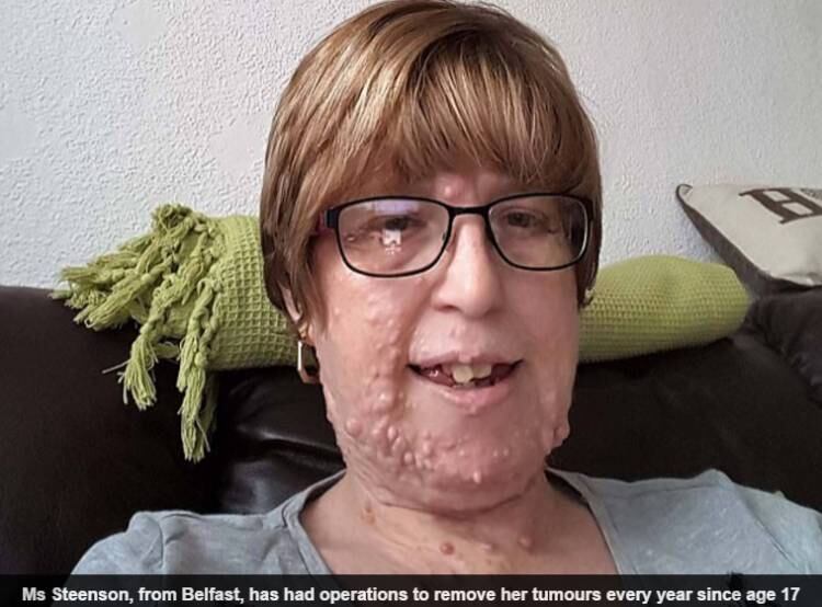 Apesar
de ter feito várias cirurgias para remover os tumores quase todos os anos desde
os 17 anos, eles continuam a crescer em todos os lugares, até mesmo entre os
dedos das mãos e dos pés