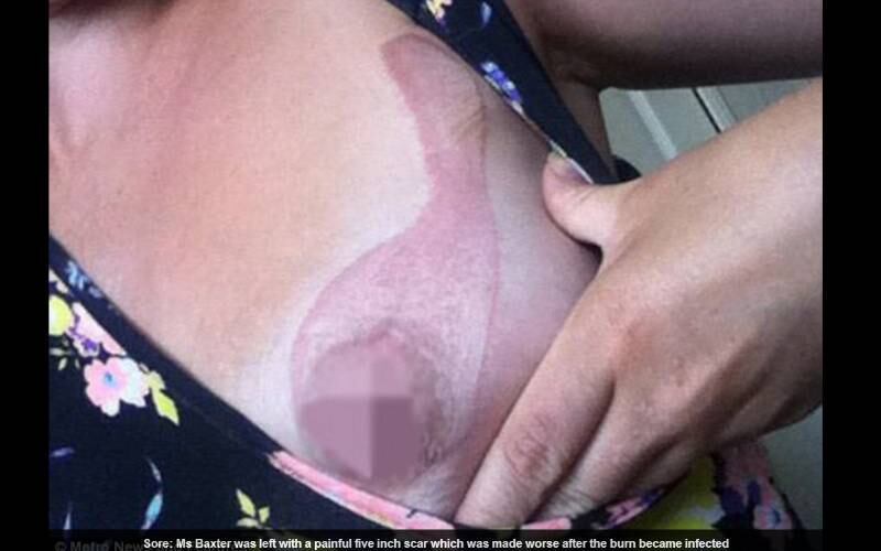 Baxter foi levada às pressas para o hospital, onde os médicos tentaram tratar a ferida com uma pomada antibiótica e analgésicos. A mulher, de 24 anos, disse ao Daily Mail que, quando acordou, o telefone estava tão quente que ela mal conseguia tocá-lo.
— Eu durmo nua e esta grande marca vermelha estava toda de um lado do mamilo

VEJA TAMBÉM: Calor: superaquecimento de eletrônicos pode causar prejuízos e acidentes graves