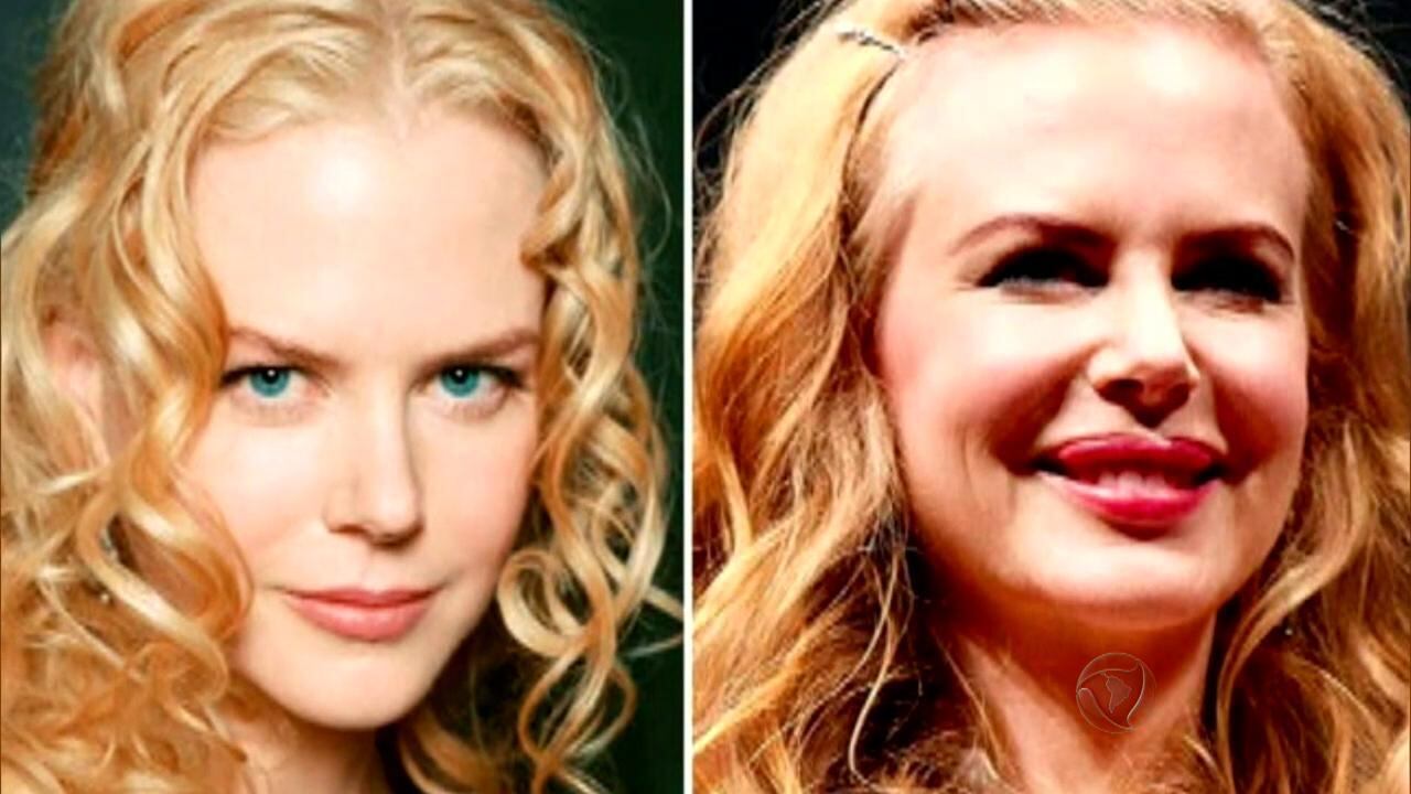 A bela Nicole Kidman recebeu críticas dos próprios fãs após o procedimento

• Assista aos programas jornalísticos da Record no r7.com/play
