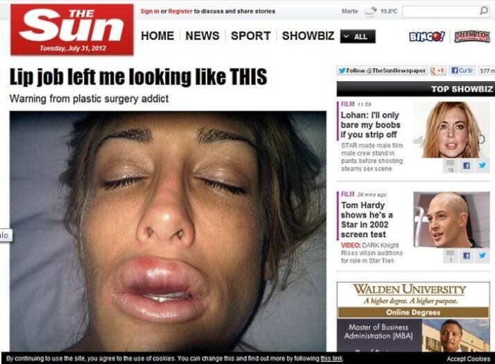 Em 2012, o vício em cirurgias plásticas fez a modelo londrina Laura Summers, de 27 anos, ficar com a boca inchada como se tivesse levado um soco.
A modelo, que gastou 60 mil libras (R$ 192 mil) , acordou com o lábio extremamente inchado, quatro vezes maior do que seu tamanho normal