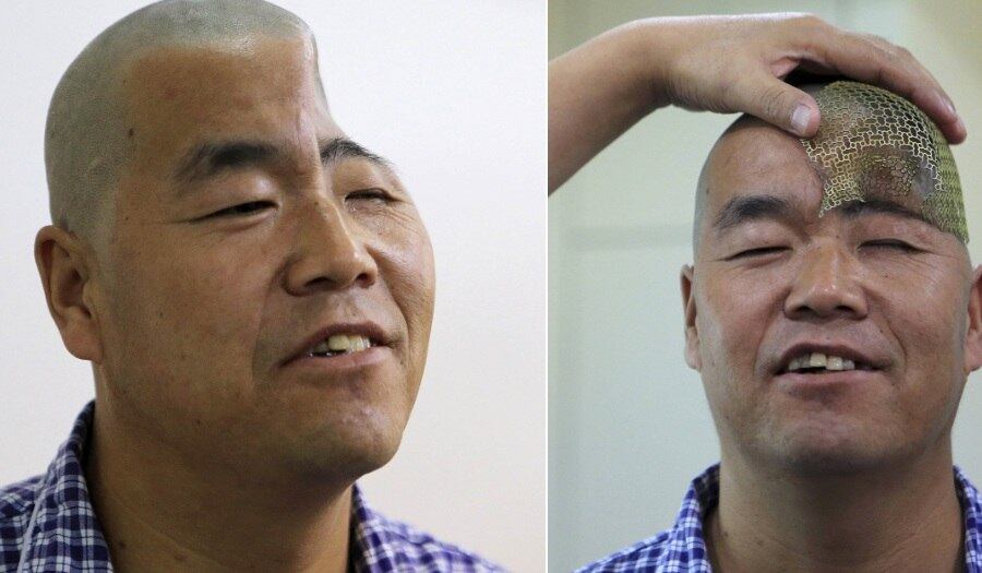 Após ter o crânio esmagado após cair do terceiro andar de um prédio, o fazendeiro, de 46 anos de idade, terá a cabeça reconstruída com titânio com a ajuda de uma impressora 3D. Nesta quinta-feira (27), o chinês passou por uma bateria de exames no hospital de Xi'an, na Província de Shaanxi, na China, antes de realizar a operação. As informações são do jornal South China Morning Post