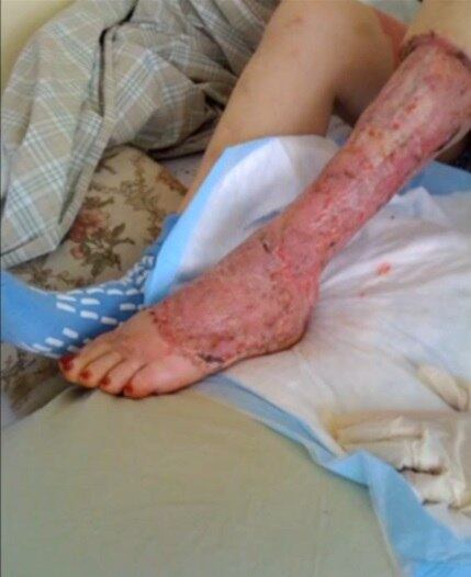 Maggie Ashe, de 33 anos, teve que lutar pela
vida logo após um dos momentos mais felizes de sua vida, em agosto de 2014. Ao
dar à luz sua filha, a jovem contraiu uma bactéria rara que começou a "comer” sua carne. Após
passar semanas de dor e angústia e até entrar em coma, Maggie finalmente
conseguiu se livrar da bactéria que corroeu parte de sua gordura e músculos do
quadril e estômago. Conheça o problema de Maggie
