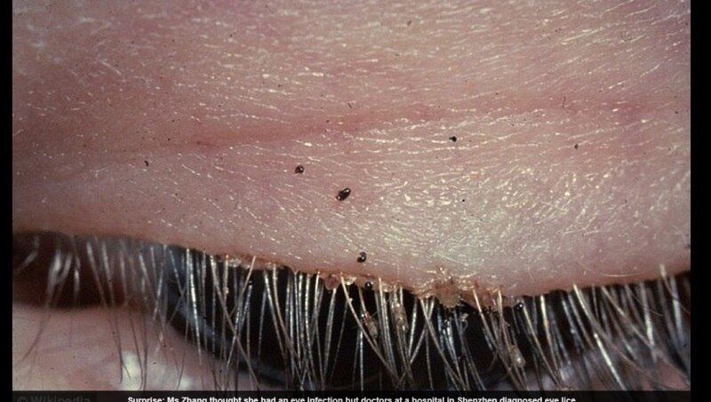 O olho dela estava extremamente vermelho e ela não conseguia parar de coçá-lo