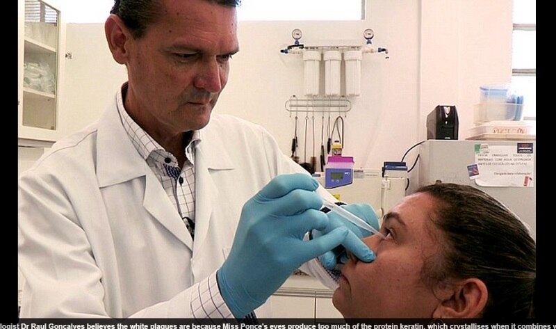 Segundo Laura, somente um especialista sugeriu que o olho
dela talvez produza queratina em excesso, por isso os cristais são formados.
— Até mesmo os médicos disseram que nunca viram alguma coisa
como essa.
Por enquanto, o médico indicou que Laura passasse gotas de
nitrato de prata, para diminuir as infecções.
— Agora eu posso ir trabalhar e espero que descubram a cura
para meu problema