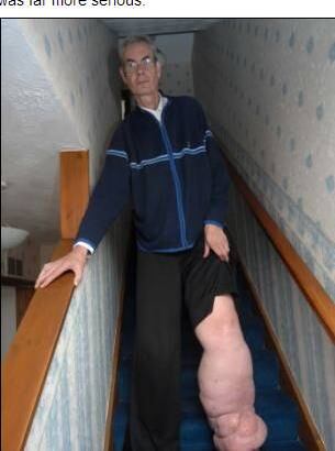 Após entrar em contato com
o primeiro-ministro da Escócia, Alex Salmond, Cull finalmente conseguiu
que sua operação fosse realizada. 


― Até onde eu sei, é um procedimento cirúrgico para remover
todo o tecido na parte inferior da minha perna