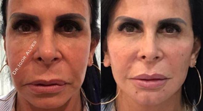 Gretchen foi uma das famosas que se rendeu à harmonização facial
