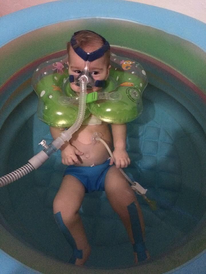 Miguel
é portador da mais grave manifestação da doença: a AME tipo 1, na qual os
sintomas de atrofia muscular surgem quando a criança tem entre zero e seis meses. O
menino não consegue respirar sozinho — apenas com o auxílio de um aparelho