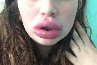 — O hematoma é o efeito instantâneo, e que pode levar de 10 a 14 dias para desaparecer. Um dos maiores perigos do produto é que é impossível saber qual a medida e o tempo certos de sucção para cada pessoa ter o resultado desejado. É impossível saber como vai ficar, pode ficar de um tamanho desproporcional. O organismo interpreta como um trauma, é como se a pessoa batesse a mucosa