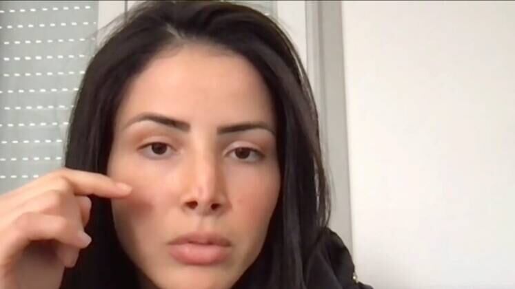 Em entrevista à equipe da Record TV, ela revela o motivo de ter decidido mudar a aparência: "Eu tinha um ossinho no nariz e era preciso lixar". Esse tipo de alteração chega a custar até R$ 2 mil. Por causa do erro, ela não conseguiu mais trabalhar com modelo, entrou em depressão e, por vergonha, chegou a mudar de país