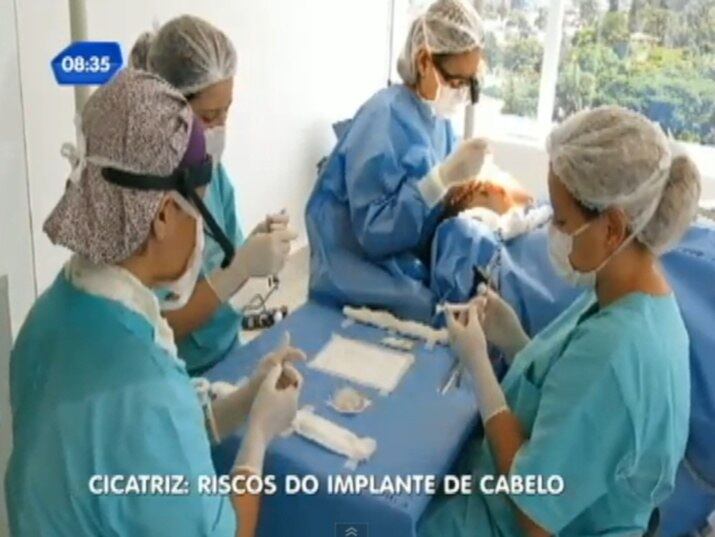 O procedimento do implante capilar demora 12 horas, e pode ser dividido
em dois dias
+ Implante capilar: conheça os riscos do procedimento