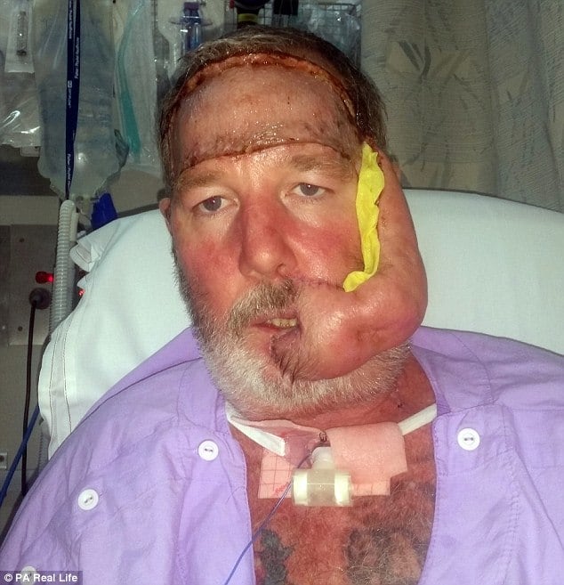 O que parecia uma afta se tornou um transtorno na vida de Peter Lisle, de 46 anos. O pequeno incômodo, na verdade, era um câncer de pele agressivo, que devastou sua mandíbula. As informações são do Daily Mail