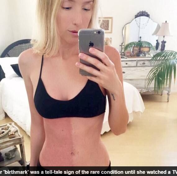 A cantora mora na Califórnia (EUA) e tem 33 anos. Em
2009, ela foi diagnosticada com uma condição rara chamada quimerismo. Tudo no
lado esquerdo do corpo de Taylor é um pouco maior. Ela tem dois sistemas imunes
e dois fluxos de sangue. A cantora é literalmente dois corpos em um só