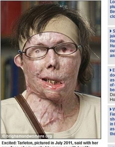 Em março de 2013, depois de ter o rosto queimado pelo marido, Carmen Tarleton, de 44 anos, conseguiu um transplante facial