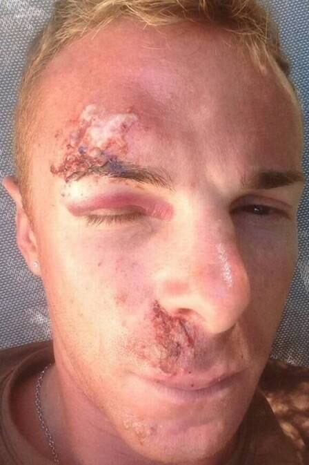 O ciclista Riccardo Riccò teve seu rosto machucado depois de sofrer um tombo da bicicleta durante a descida do Mont Ventoux, na França, em julho. O atleta foi levado ao hospital e depois de alguns dias compartilhou uma foto do estrago em sua rede social