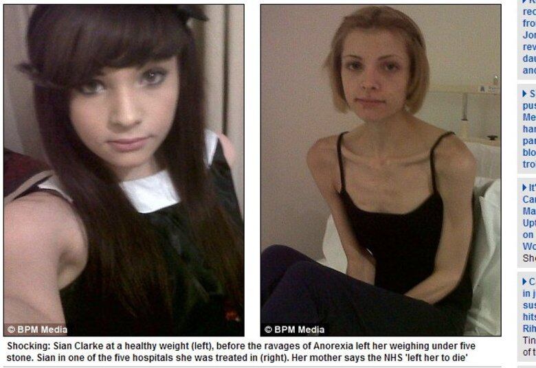 Sian Clarke, de 19 anos de idade e 29 kg, quase morreu em junho de 2013 por descaso dos hospitais. De acordo com a mãe da menina, Denise Clarke, 40 anos, foram oito meses de sofrimento até que sua filha conseguisse ser atendida em uma clínica