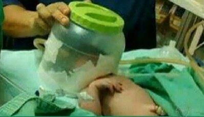 Enfermeiros cortaram o pote e fizeram um capacete de oxigênio