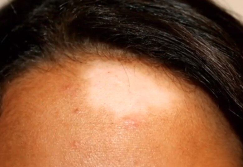 Embora a doença seja descrita há mais de 2 mil anos, ainda é misteriosa para a ciência e desconhecida da população. Ela acomete igualmente homens e mulheres, em qualquer idade e está 100% ligada ao fator emocional. Portanto, o estresse é um gatilho