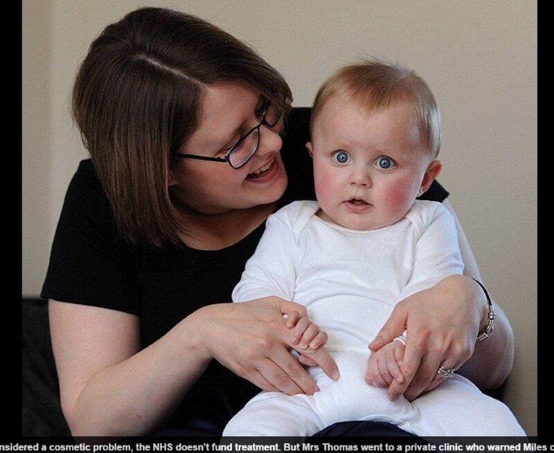 A clínica recomendou
tratamento com o capacete especial, que permite que todas as partes do cérebro
se desenvolvam da mesma maneira. Por causa da pressão que o crânio com essa
forma faz nas partes mais apertadas, o desenvolvimento fica debilitado, explicou
a mãe