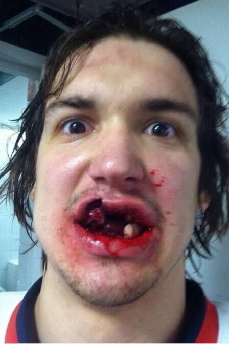 Mitch Callahan, jogador de hóquei, teve sua boca completamente destruída depois de ser atingido por um disco no jogo entre Detroit Red Wings, seu clube, e o Iowa Wild. Mitch perdeu os dois dentes da frente, mais outros quatro e teve seus lábios rasgados. Antes de ser levado para o hospital, Mitch tirou uma selfie para compartilhar esse momento com seus seguidores