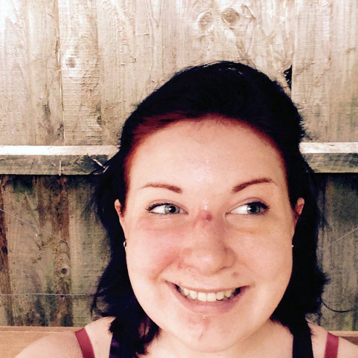 Em entrevista ao jornal britânico The Sun, ela detalhou o acidente que a deixou com a boca desfigurada. 

— Meu namorado e eu tinhamos ido a uma piscina e estávamos voltando de bicicleta. Então, nossas rodas dianteiras se tocaram, e isso foi tudo o que precisou para me arremessar para a frente. Voei direto por cima do guidão e bati com a cara no chão