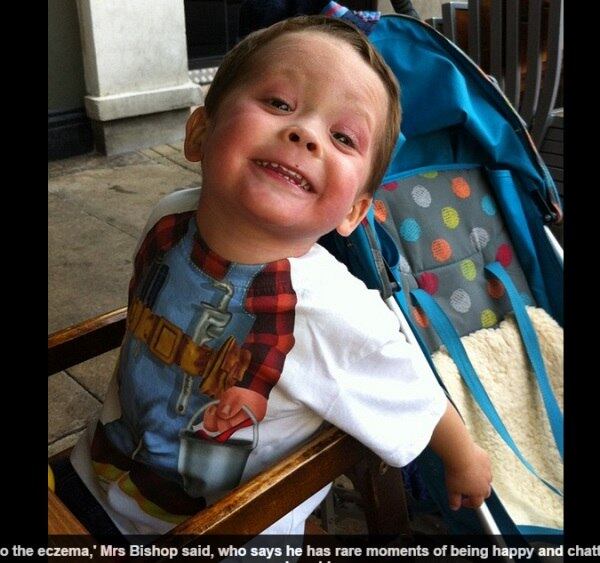 A pele dos pés e das
pernas do pequeno Morgan ficou tão fina que ele não pode mais andar, e precisa
se locomover por meio de uma “motinho”, para não encostar no chão. Além disso,
ele só frequenta a escola por metade do tempo normal e não consegue brincar com
os amiguinhos, conta a mãe