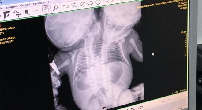 Crianças nasceram unidas pelo tronco, mas não compartilham órgãos vitais