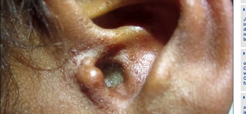 O médico Vikram Yadav, que tratou o homem e depois divulgou
o vídeo do procedimento, explicou que moscas invadiram a orelha do homem
enquanto ele dormia