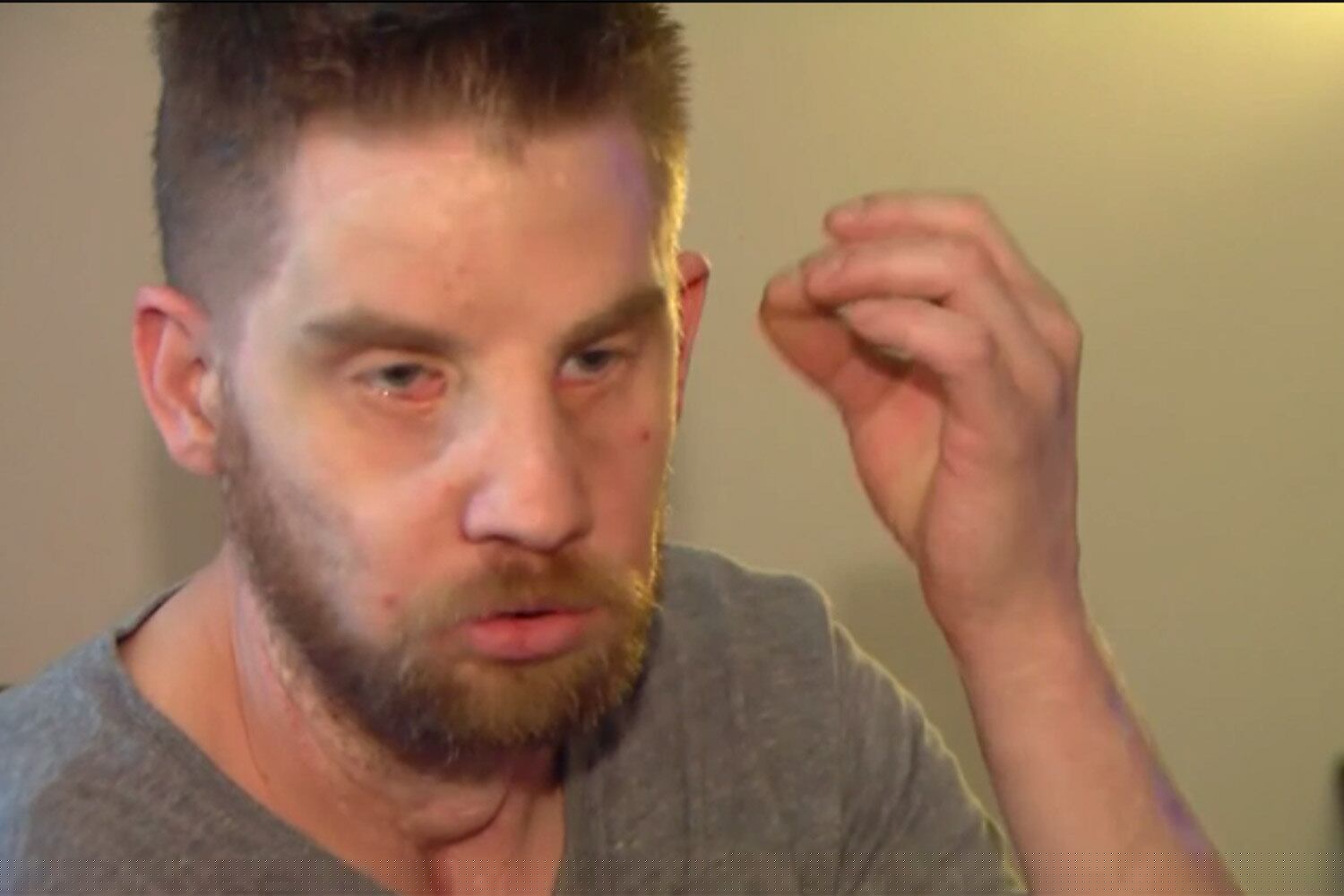 Cinco anos depois da operação, ele deixou a barba crescer, e tem apenas traços menores de deformação em torno de seus olhos — nos quais uma equipe de médicos continua tentando amenizar