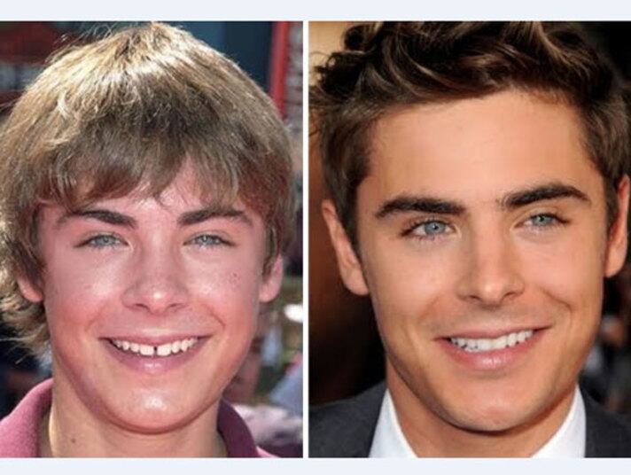 O gatíssimo Zac Efron mudou bastante com o tempo. O galã tinha o cabelo tigelinha e dentes tortos 