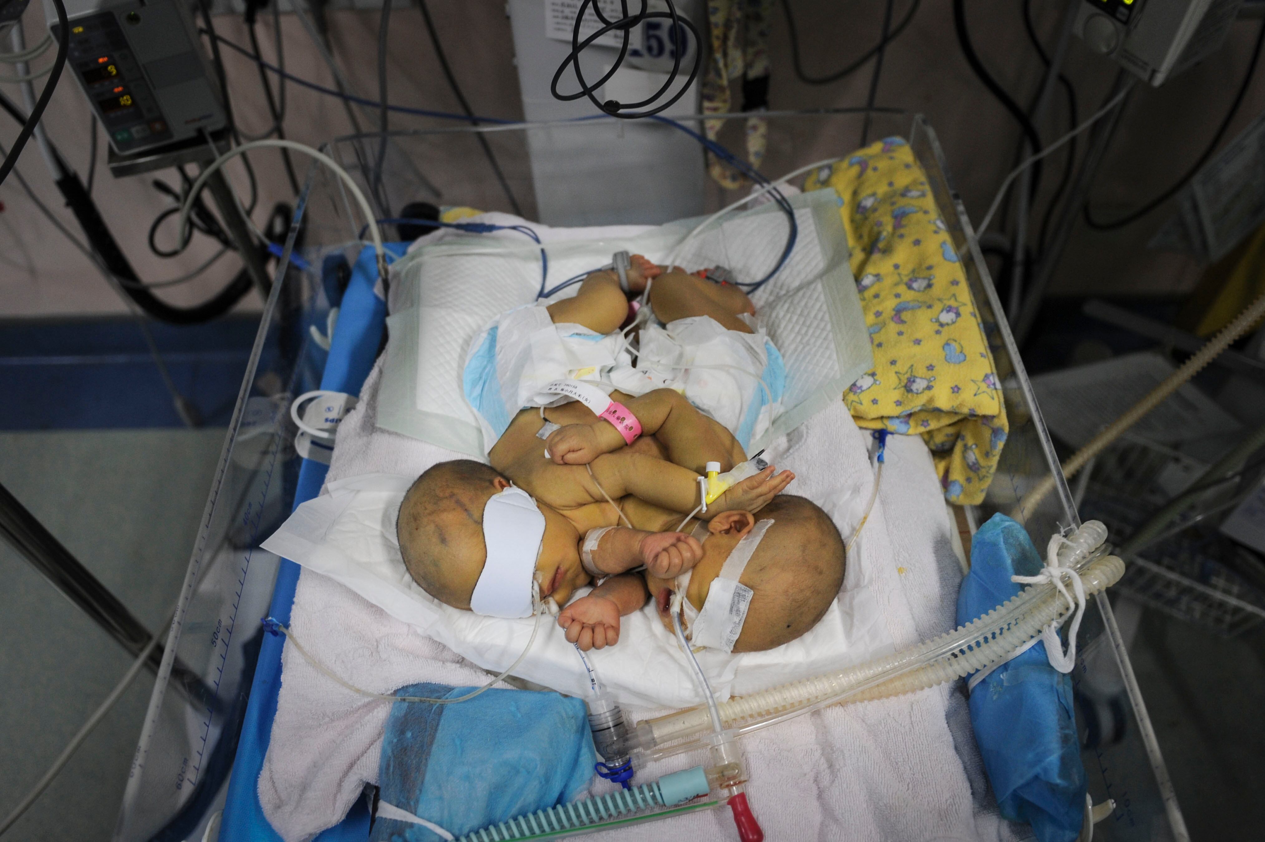 Os recém-nascidos gêmeos siameses lutam para sobreviver já que a separação poderá ser difícil, de acordo com os médicos. Hoje, eles recebem tratamento médico na UTI (Unidade de Terapia Intensiva) no Hospital de Crianças Hunan, na cidade de Changshad, na China

Recuperação de irmãs separadas em cirurgia vira esperança para irmãos siameses