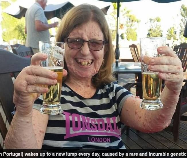 Noreen
foi diagnosticada com neurofibromatose rara e incurável tipo 1. Qualquer um dos
diversos tumores que cobrem seu corpo pode se tornar câncer, o que faz com ela
tema por sua vida todos os dias. A doença é causada por uma mutação genética, o
que faz com que o tecido nervoso cresça incontrolavelmente