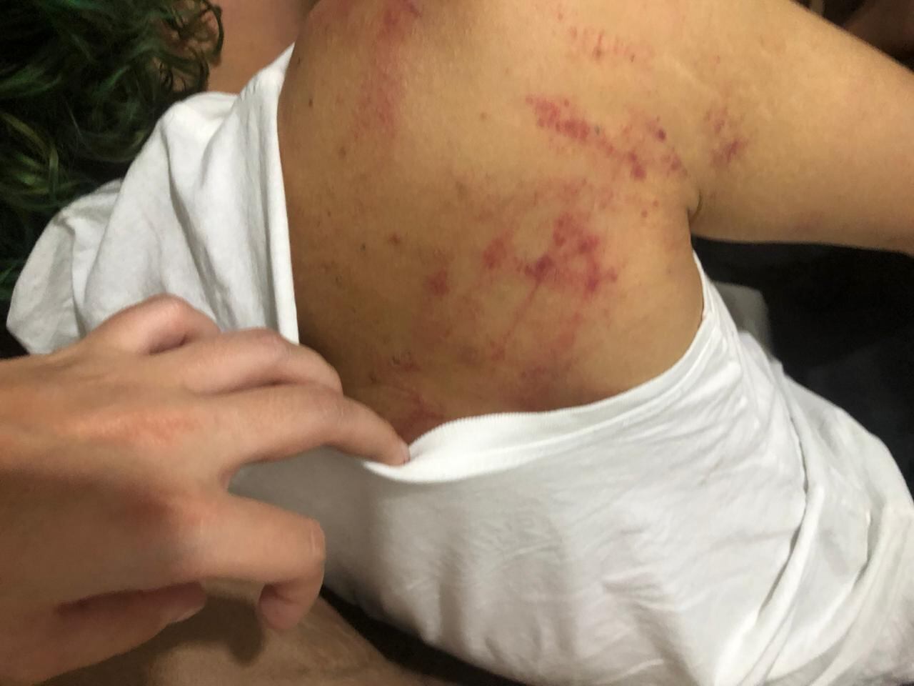 Michael Giordano Martins Pinheiros, de 34 anos, mostra marcas da agressão