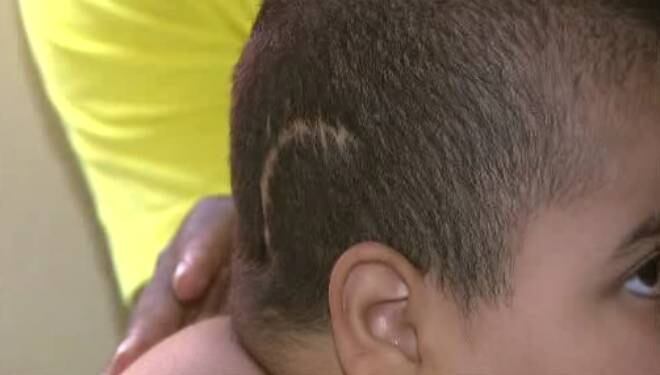 Guilherme, que não consegue andar nem falar, começou a engordar além do normal aos três anos e já passou por 24 cirurgias