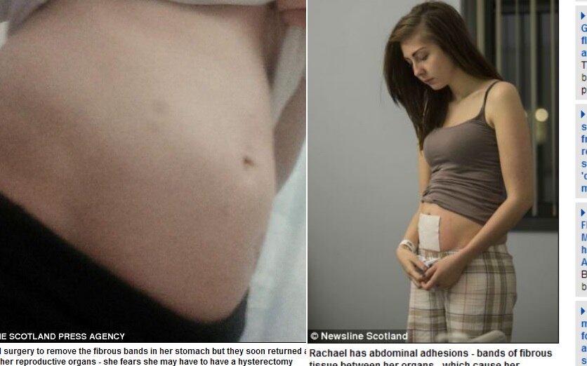 

Todas as vezes que Rachael Harley come, ela sofre com dores de
estômago. Além disso, sua barriga cresce tanto que parece que está grávida.
Depois de passar por uma operação em julho, os médicos descobriram que a adolescente
do Reino Unido sofre com tecidos fibrosos que se criam em seu apêndice e estômago. As informações
são do site Daily Mail desta terça-feira (3)



Doença rara faz homem acreditar que está morto