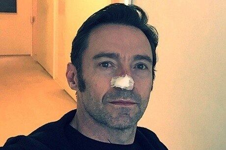 Hugh Jackman com curativo no nariz