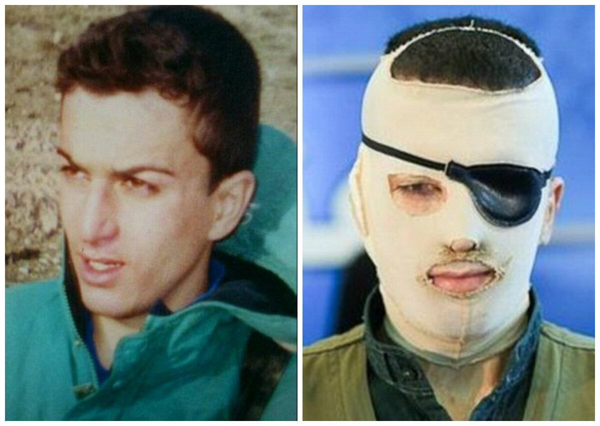 Um homem iraniano, identificado apenas como
Hamid S, atacou com ácido outro homem em 2005. A vítima, Davoud Roshanaei,
perdeu um olho e uma orelha no ataque