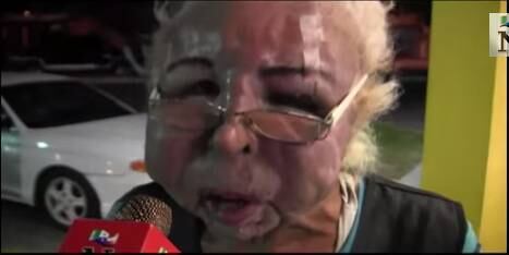 Nos
últimos 17 anos, Hugo Hernandez Garcia,
de Nuevo Laredo, no México, transformou
completamente seu rosto. Na tentativa de corrigir imperfeições a baixo custo,
ele injetou diversos produtos, entre eles óleo de bebê