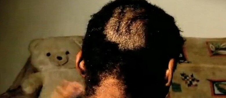 O amigo da menina estuprada conseguiu escapar, mas levou 40 pontos na cabeça por causa das agressões