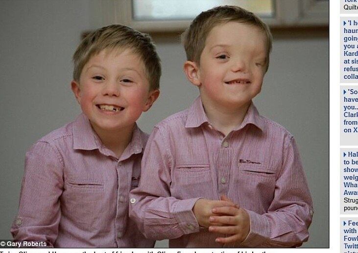 Para a maioria das mães, o momento de ver o filho após o parto é o mais esperado. Mas não foi assim para Charlene Machin. A mãe, de 33 anos, deu à luz os gêmeos Oliver e Harry, mas um deles nasceu com metade do rosto deformado. Harry passou por três cirurgias para reposicionar sua órbita ocular e, em julho do ano passado, foi realizada uma operação de dez horas para remover a frente do seu rosto e do crânio com o objetivo de reposicionar o cérebro. Entenda a história