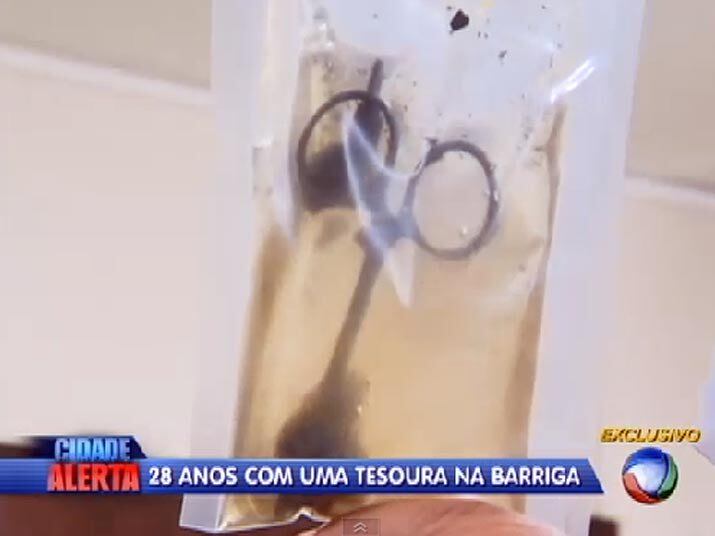 De acordo com os Raios-X, a tesoura aparece do lado direito, perto de órgãos como útero, ovário e intestino. Dona Sueli conta que, logo depois do parto, passou por vários médicos, mas nenhum descobriu o que lhe provocava tantas dores. Assista ao vídeo!

