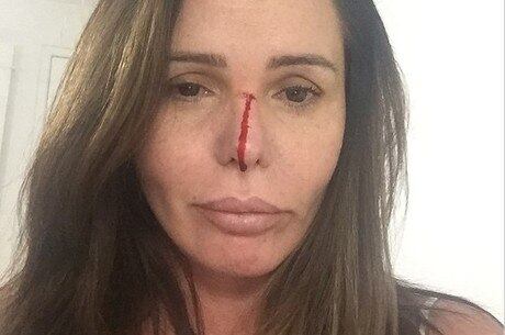 Cristina Mortágua compartilha foto em que aparece machucada