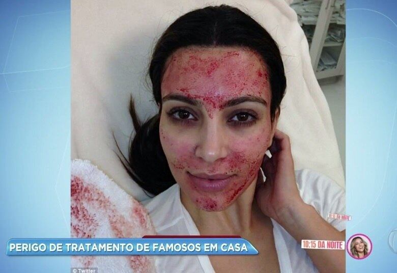 "Ele pode ser indicado para o tratamento de melasma, de algumas manchas. Para crescimento dos cabelos. [Para] estrias também ele tem muitos benefícios", explica a dermatologista Fabiana Simões Pietro 